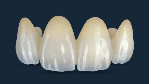 BruxZir Esthetic 4-Unit Crown