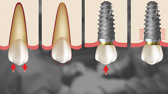 Placing Implant Illustration