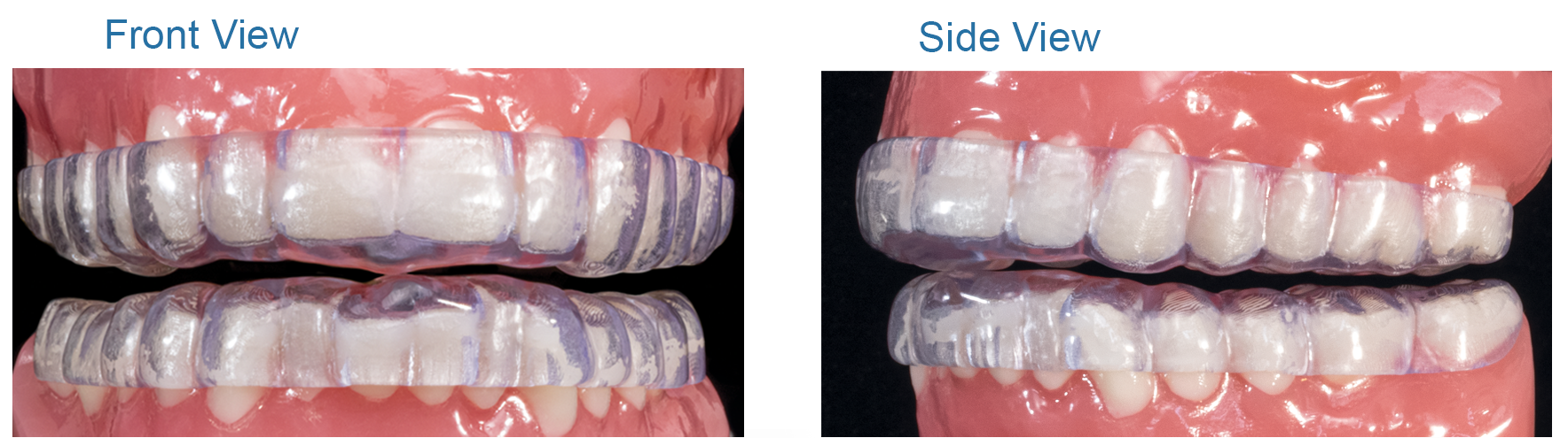 Omnisplint front and side view