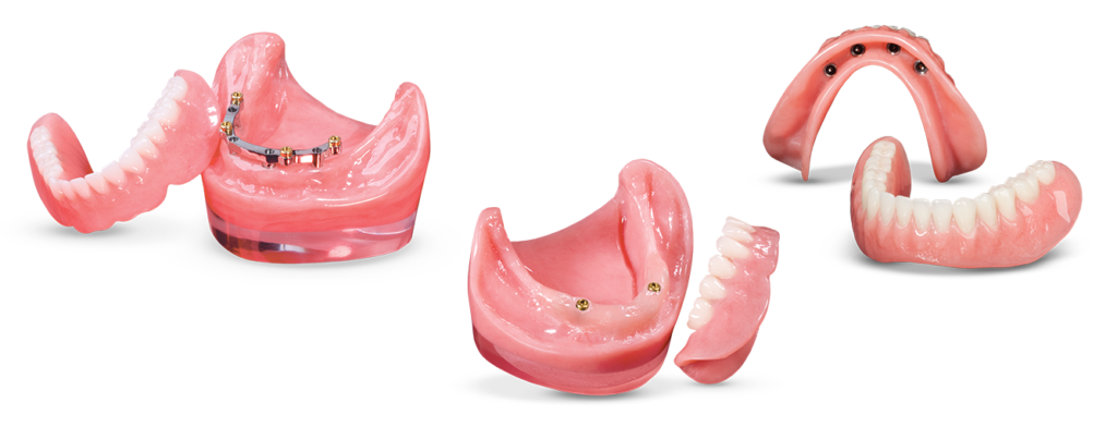 Implant Overdentures Products