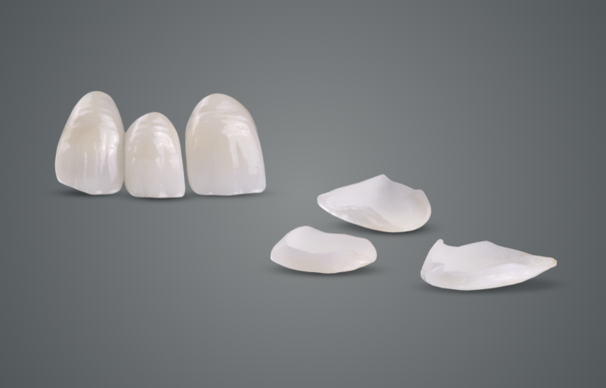 Veneers
