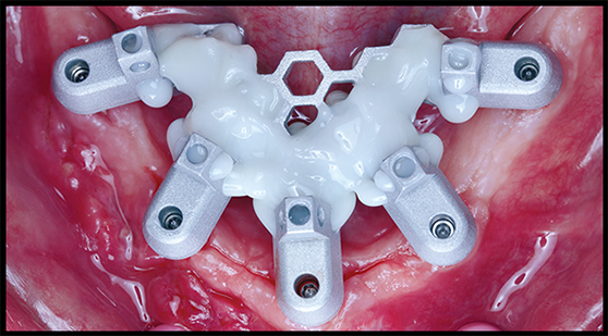OPTISPLINT in mouth